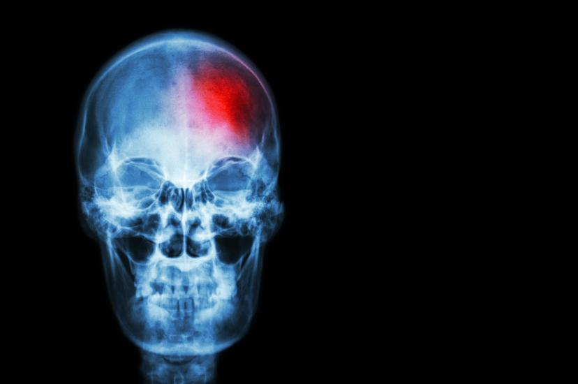 Stroke. Film x-ray of human skull with red area