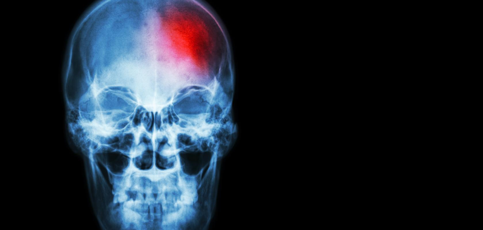 Stroke. Film x-ray of human skull with red area